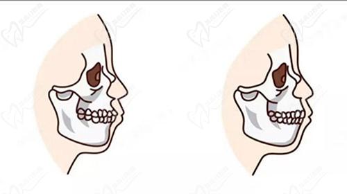 牙性凸嘴和骨性凸嘴