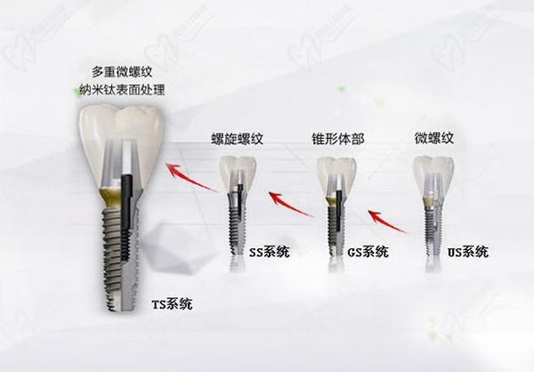 韩国登腾种植牙