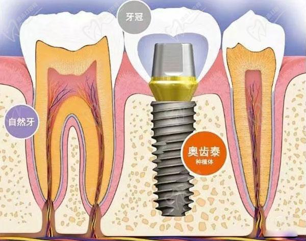 石家庄德尔口腔医院种植牙多少钱