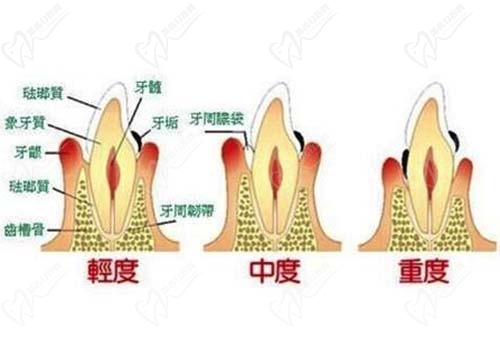 牙周炎发展流程图
