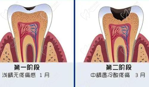 牙齿龋坏过程图解