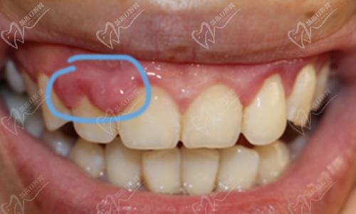 牙龈癌怎么治疗图片