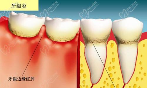 牙龈癌和牙龈炎的区别图片