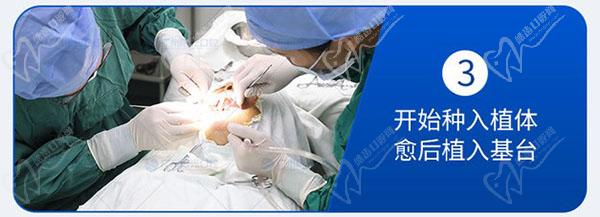 广州曙光口腔医院种植牙流程