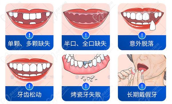 广州曙光口腔医院种植牙优势