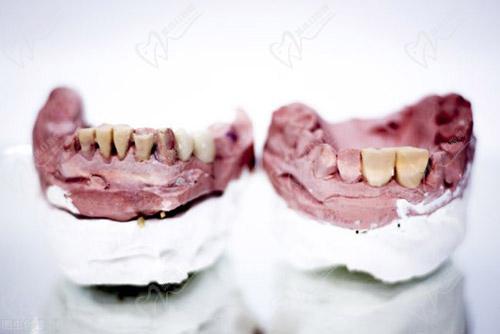 牙龈癌的早期三大症状图片分享一般能活多少年本文揭秘