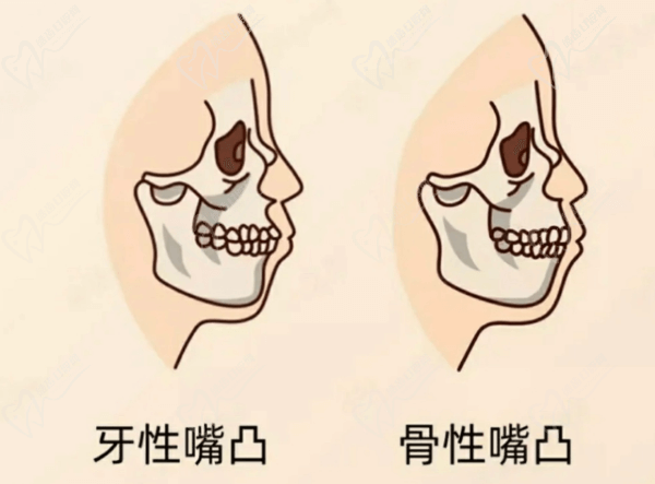 牙性嘴凸和骨性嘴凸对比