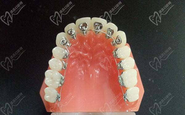 自锁托槽矫正牙齿周期多长