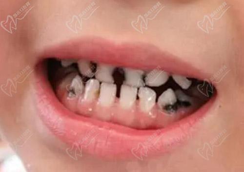 儿童乳牙烂掉只剩牙根图片