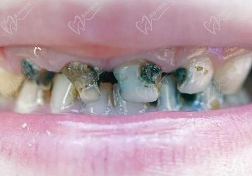 乳牙残根的危害