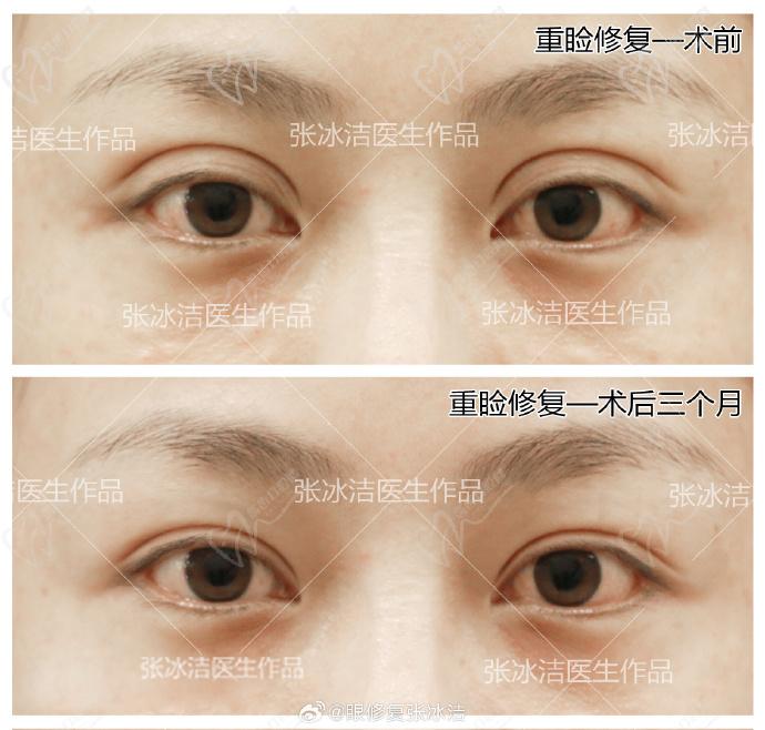 张冰洁双眼皮修复案 例图：不适配的欧 式眼修复