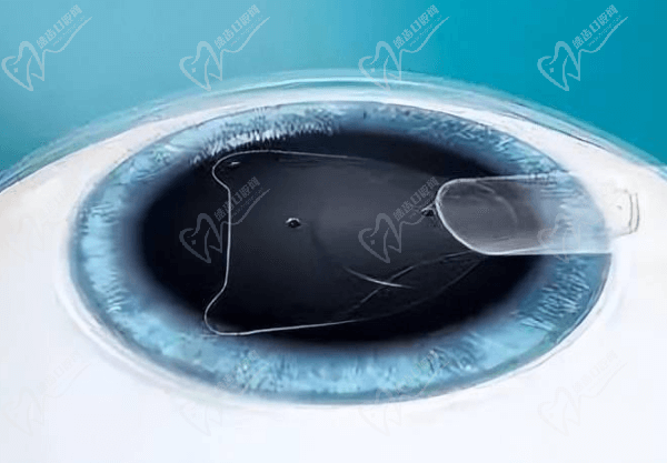 晶体植入近视手术